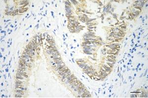 Immunohistochemistry was performed on paraffin-embedded human sigmoid colon carcinoma using catenin beta 1 antibody (ABIN7797925), 1:200). (CTNNB1 抗体)