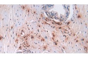 Detection of DEFa3 in Human Prostate Tissue using Polyclonal Antibody to Defensin Alpha 3, Neutrophil Specific (DEFa3) (DEFa3 抗体  (AA 21-94))