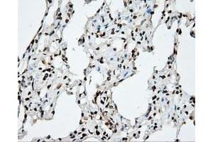 Immunohistochemical staining of paraffin-embedded Adenocarcinoma of ovary tissue using anti-DAPK2 mouse monoclonal antibody. (DAPK2 抗体)