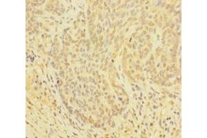 Immunohistochemistry of paraffin-embedded human ovarian cancer using ABIN7154046 at dilution of 1:100 (Glutaredoxin 1 抗体  (AA 1-106))