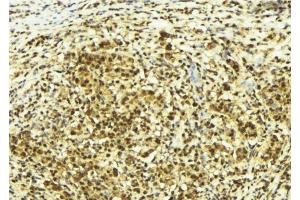 ABIN6278721 at 1/100 staining Human breast cancer tissue by IHC-P. (SUPT4H 抗体  (C-Term))