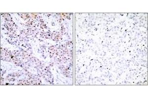 Immunohistochemistry analysis of paraffin-embedded human breast carcinoma tissue, using Estrogen Receptor-alpha (Ab-106) Antibody. (Estrogen Receptor alpha 抗体  (AA 71-120))