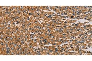 Immunohistochemistry of paraffin-embedded Human lung cancer tissue using PARP11 Polyclonal Antibody at dilution 1:30 (PARP11 抗体)