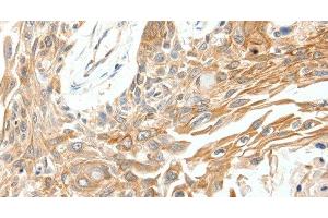 Immunohistochemistry of paraffin-embedded Human breast cancer tissue using SCN11A Polyclonal Antibody at dilution 1:40 (SCN11A 抗体)