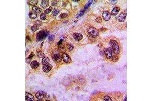 Immunohistochemical analysis of GABRD staining in human lung cancer formalin fixed paraffin embedded tissue section. (GABRD 抗体)