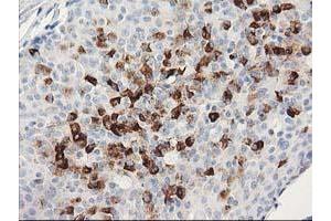 Immunohistochemical staining of paraffin-embedded Adenocarcinoma of Human breast tissue using anti-MGLL mouse monoclonal antibody. (MGLL 抗体)