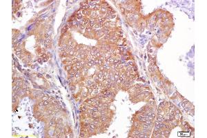 Formalin-fixed and paraffin embedded human breast carcinoma labeled with Rabbit Anti PALB2 Polyclonal Antibody, Unconjugated (ABIN670536) at 1:200 followed by conjugation to the secondary antibody and DAB staining
