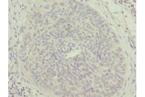 Immunohistochemistry of paraffin-embedded human cervical cancer using ABIN7159869 at dilution of 1:100 (Mtfp1 抗体  (AA 1-166))