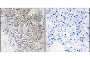 Immunohistochemistry analysis of paraffin-embedded human breast carcinoma, using p70 S6 Kinase (Phospho-Thr421) Antibody. (RPS6KB1 抗体  (pThr444))