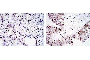 Immunohistochemical analysis of paraffin-embedded lung cancer (left) and ovary tumour tissues (right) using CCNB1 antibody with DAB staining. (Cyclin B1 抗体)