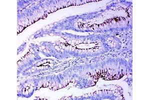 IHC-P: Profilin 2 antibody testing of human intestinal cancer tissue (PFN2 抗体  (C-Term))