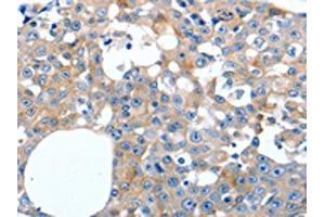 The image on the left is immunohistochemistry of paraffin-embedded Human breast cancer tissue using ABIN7191279(LILRB3 Antibody) at dilution 1/20, on the right is treated with synthetic peptide. (LILRB3 抗体)
