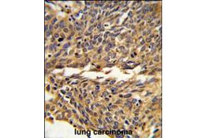 Formalin-fixed and paraffin-embedded human lung carcinoma reacted with EXOC5 Antibody , which was peroxidase-conjugated to the secondary antibody, followed by DAB staining. (EXOC5 抗体  (C-Term))