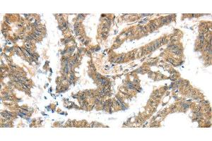 Immunohistochemistry of paraffin-embedded Human colon cancer tissue using KCNG3 Polyclonal Antibody at dilution 1:40 (KCNG3 抗体)