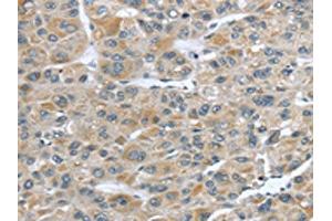 The image on the left is immunohistochemistry of paraffin-embedded Human liver cancer tissue using ABIN7190228(CFAP45 Antibody) at dilution 1/25, on the right is treated with synthetic peptide. (CCDC19 抗体)