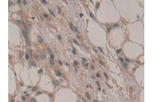 Detection of ATP1b3 in Human Skin cancer Tissue using Polyclonal Antibody to Sodium/potassium Transporting ATPase Subunit Beta-3 (ATP1b3)