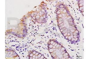 Formalin-fixed and paraffin embedded human colon carcinoma labeled with Anti-HMGA1/HMG-I/HMG-Y Polyclonal Antibody, Unconjugated (ABIN736626) at 1:200 followed by conjugation to the secondary antibody and DAB staining. (HMGA1 抗体  (AA 51-107))