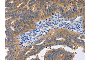 The image on the left is immunohistochemistry of paraffin-embedded Human ovarian cancer tissue using ABIN7191576(NBEA Antibody) at dilution 1/60, on the right is treated with synthetic peptide. (Neurobeachin 抗体)