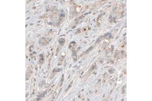 Immunohistochemical staining (Formalin-fixed paraffin-embedded sections) of human breast cancer with CDK5RAP2 monoclonal antibody, clone CL3392  shows centrosome-like immunoreactivity in tumor cells. (CDK5RAP2 抗体)