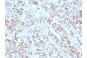 Formalin-fixed, paraffin-embedded human Gastric Carcinoma stained with CD269 / TNFRSF17 Mouse Monoclonal Antibody (BCMA/2366).