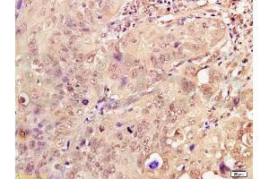 Formalin-fixed and paraffin embedded human breast carcinoma labeled with Anti-Dnmt3a Polyclonal Antibody, Unconjugated (ABIN669336) at 1:200, followed by conjugation to the secondary antibody and DAB staining (DNMT3A 抗体  (AA 26-100))