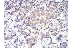 Immunohistochemical analysis of paraffin-embedded breast cancer tissues using PLCG1 mouse mAb with DAB staining.