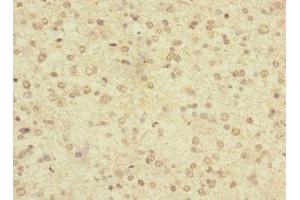 Immunohistochemistry of paraffin-embedded human glioma using ABIN7158190 at dilution of 1:100 (LRRC4C 抗体  (AA 201-500))