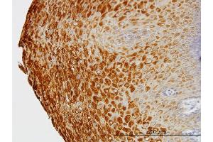 Immunoperoxidase of monoclonal antibody to KRTHB1 on formalin-fixed paraffin-embedded human esophagus. (KRT81 抗体  (AA 1-202))