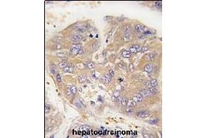 Formalin-fixed and paraffin-embedded human hepatocarcinoma tissue reacted with Dtnbp1 Antibody (N-term) (ABIN389169 and ABIN2839335) , which was peroxidase-conjugated to the secondary antibody, followed by DAB staining. (DTNBP1 抗体  (N-Term))