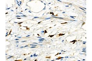 ABIN6261701 and ABIN6276667 at 1/100 staining Human ovarian cancer and adjacent normal tissues by IHC-P. (Fc gamma RII (CD32) (C-Term) 抗体)