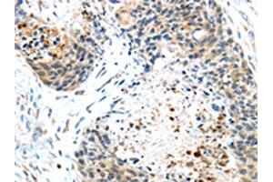 The image on the left is immunohistochemistry of paraffin-embedded Human esophagus cancer tissue using ABIN7131404(TMPRSS4 Antibody) at dilution 1/45, on the right is treated with fusion protein. (TMPRSS4 抗体)