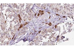 ABIN6275666 at 1/100 staining Human Melanoma tissue by IHC-P. (UEVLD 抗体  (N-Term))