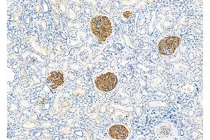 ABIN6260730 and ABIN6279282 at 1/100 staining Human kidney cancer and adjacent normal tissues by IHC-P. (CDR1 抗体  (N-Term))