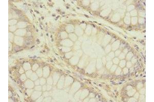 Immunohistochemistry of paraffin-embedded human colon cancer using ABIN7142631 at dilution of 1:100 (Serotonin Receptor 3B 抗体  (AA 22-238))