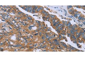 Immunohistochemistry of paraffin-embedded Human ovarian cancer using GAB2 Polyclonal Antibody at dilution of 1:40 (GAB2 抗体)