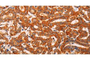 Immunohistochemistry of paraffin-embedded Human thyroid cancer using SLC25A4 Polyclonal Antibody at dilution of 1:40 (SLC25A4 抗体)