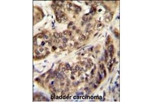 STK32A Antibody (N-term) (ABIN655889 and ABIN2845288) immunohistochemistry analysis in formalin fixed and paraffin embedded human bladder carcinoma followed by peroxidase conjugation of the secondary antibody and DAB staining. (STK32A 抗体  (N-Term))