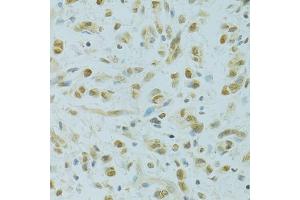 Immunohistochemistry of paraffin-embedded human gastric cancer using RCC1 antibody (ABIN5973761) at dilution of 1/100 (40x lens). (RCC1 抗体)