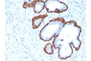 Formalin-fixed, paraffin-embedded human Prostate Carcinoma stained with Cytokeratin 5 Mouse Monoclonal Antibody (KRT5/3594). (Cytokeratin 5 抗体  (AA 316-590))