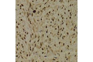 Immunohistochemistry of paraffin-embedded Human adenomyosis using PPP1R8 antibody at dilution of 1:100 (x400 lens). (PPP1R8 抗体)