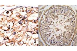 (LEFT)Formalin-fixed and paraffin-embedded human cancer tissue reacted with the primary antibody, which was peroxidase-conjugated to the secondary antibody, followed by AEC staining. (PGK2 抗体  (N-Term))