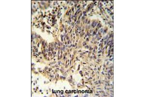RXRA Antibody IHC analysis in formalin fixed and paraffin embedded lung carcinoma followed by peroxidase conjugation of the secondary antibody and DAB staining. (Retinoid X Receptor alpha 抗体  (AA 196-224))