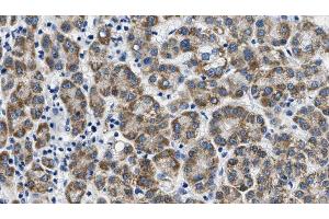 ABIN6268790 at 1/100 staining Human liver cancer tissue by IHC-P. (FSHR 抗体  (Internal Region))