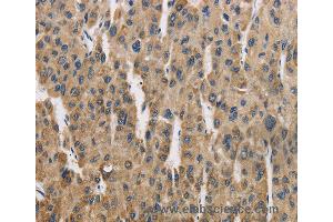 Immunohistochemistry of Human liver cancer using COX6B1 Polyclonal Antibody at dilution of 1:50 (COX6B1 抗体)