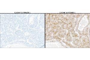 Immunohistochemistry (IHC) image for anti-Carcinoembryonic Antigen-Related Cell Adhesion Molecule 5 (CEACAM5) (AA 35-685) antibody (ABIN7453964) (Recombinant CEACAM5 抗体  (AA 35-685))