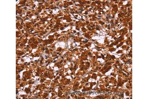 Immunohistochemistry of Human gastric cancer using HIPK1 Polyclonal Antibody at dilution of 1:30 (HIPK1 抗体)