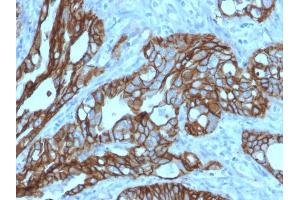 Formalin-fixed, paraffin-embedded human Colon Carcinoma stained with TACSTD2 / TROP2 Mouse Monoclonal Antibody (TACSTD2/2152). (TACSTD2 抗体  (AA 31-274))