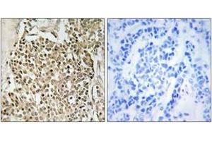 Immunohistochemistry analysis of paraffin-embedded human breast carcinoma, using CEP350 Antibody. (CEP350 抗体  (AA 671-720))