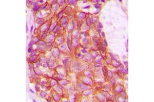 Immunohistochemical analysis of GPR159 staining in human breast cancer formalin fixed paraffin embedded tissue section. (CXCR7 抗体  (C-Term))