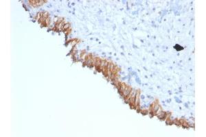Formalin-fixed, paraffin-embedded human Bladder Carcinoma stained with MAML2 Monoclonal Antibody (MAML2/1302). (MAML2 抗体)